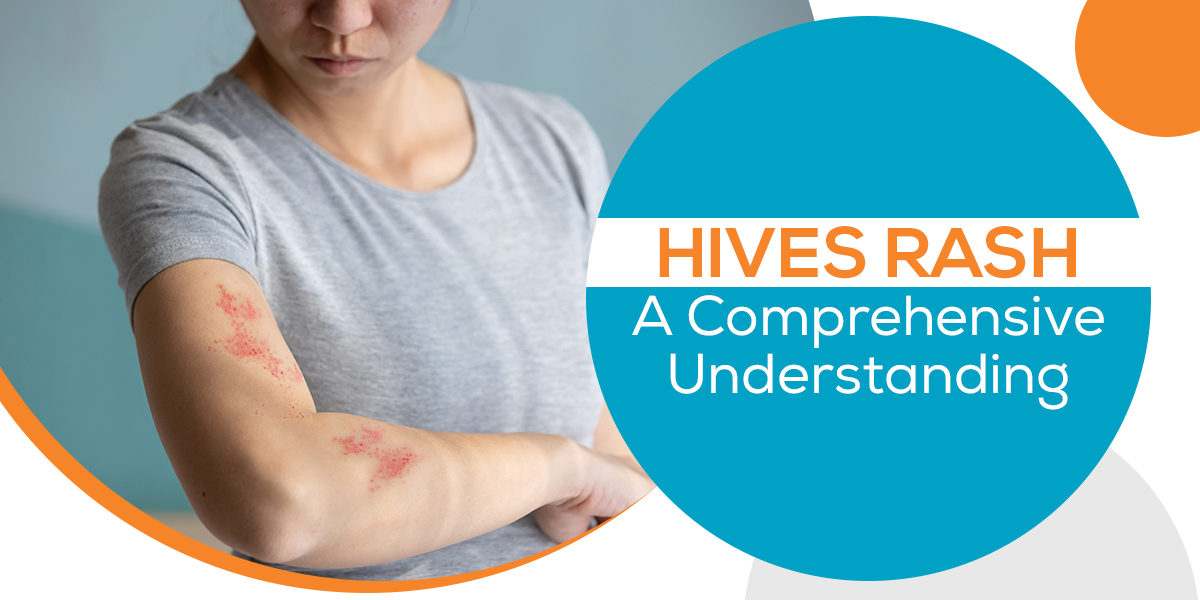 Hives Rash: A Comprehensive Understanding